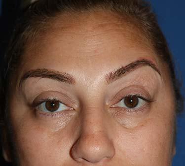 Before Results for Botox