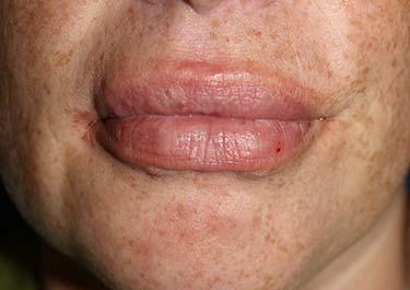 After Results for Tissue Fillers, Lip Augmentation