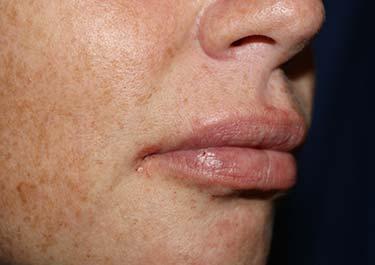 After Results for Tissue Fillers, Lip Augmentation