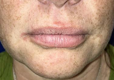 Before Results for Tissue Fillers, Lip Augmentation