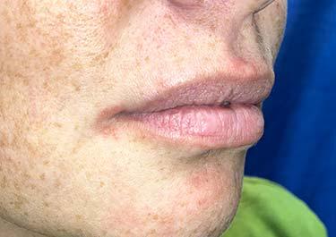 Before Results for Tissue Fillers, Lip Augmentation