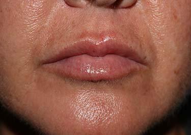 After Results for Tissue Fillers, Lip Augmentation