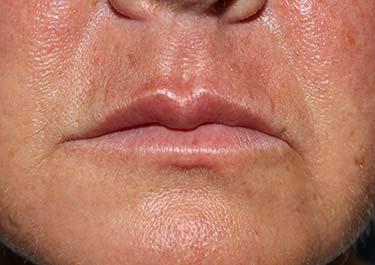 Before Results for Tissue Fillers, Lip Augmentation