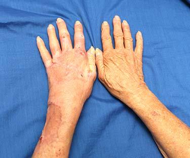 After Results for Skin Cancer, Hand Surgery