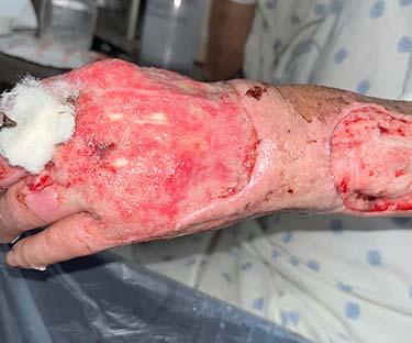 Before Results for Skin Cancer, Hand Surgery