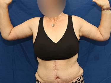 After Results for Brachioplasty / Arm Lift