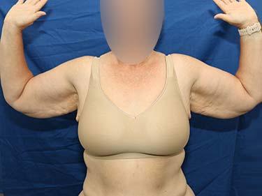 Before Results for Brachioplasty / Arm Lift