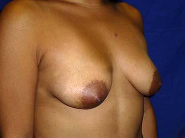 Before Results for Breast Augmentation