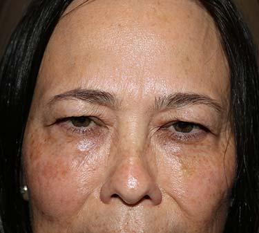 After Results for Botox