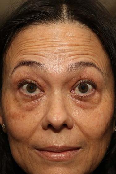 Before Results for Botox