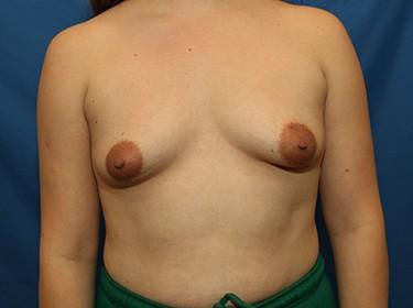 Before Results for Breast Augmentation