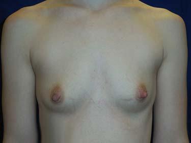 Before Results for Breast Augmentation