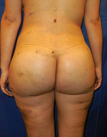 After Results for Brazilian Butt Lift / Gluteal Augmentation