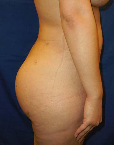 After Results for Brazilian Butt Lift / Gluteal Augmentation