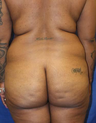 Before Results for Liposuction