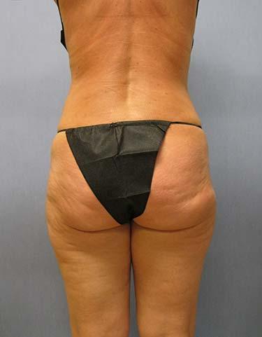 After Results for Liposuction