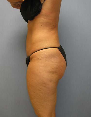 After Results for Liposuction