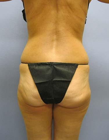 Before Results for Liposuction