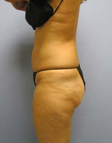 Before Results for Liposuction