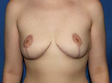 After Results for Breast Reduction