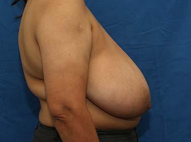 Before Results for Breast Reduction