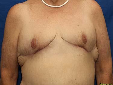 After Results for Breast Reduction