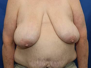 Before Results for Breast Reduction