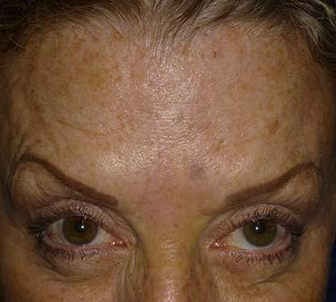 After Results for Neuromodulators (Botox / Dysport)