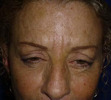 After Results for Neuromodulators (Botox / Dysport)