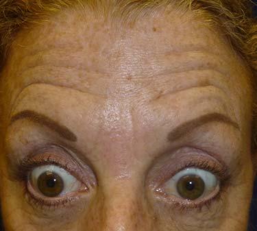 Before Results for Neuromodulators (Botox / Dysport)