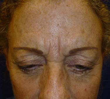 Before Results for Neuromodulators (Botox / Dysport)