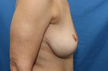 Before Results for Breast Lift / Mastopexy