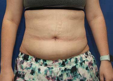 After Results for Liposuction