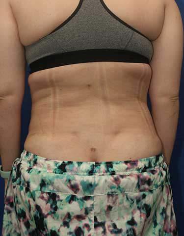 After Results for Liposuction