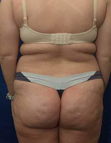 Before Results for Liposuction