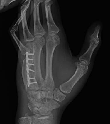 After Results for Hand Surgery