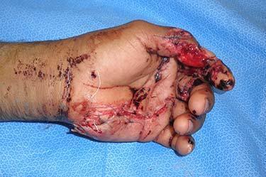 Before Results for Hand Surgery