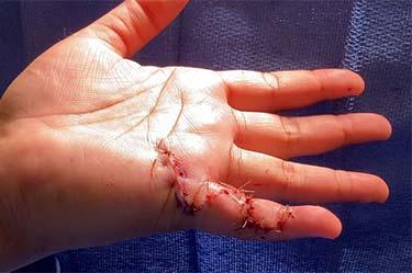 After Results for Hand Surgery