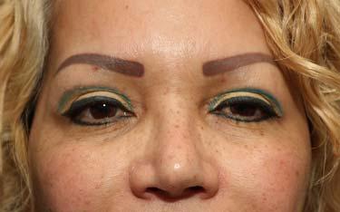 After Results for Blepharoplasty