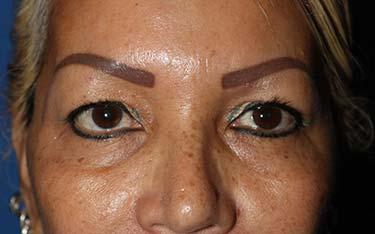 Before Results for Blepharoplasty