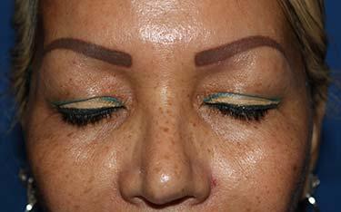 Before Results for Blepharoplasty