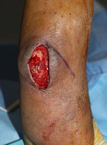 Before Results for Wound Care