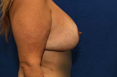 After Results for Breast Lift / Mastopexy