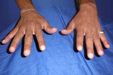 After Results for Hand Surgery