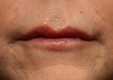 After Results for Tissue Fillers, Lip Augmentation