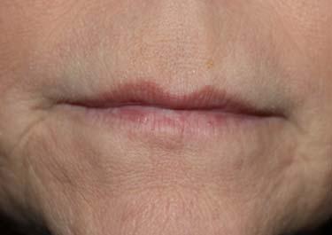 Before Results for Tissue Fillers, Lip Augmentation