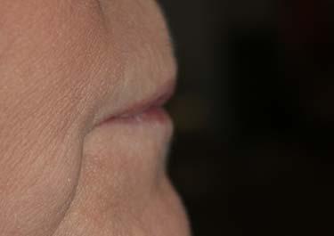 Before Results for Tissue Fillers, Lip Augmentation