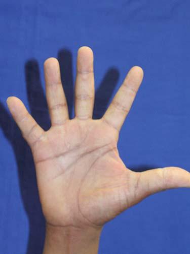 Before Results for Hand Surgery