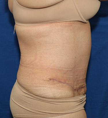 After Results for Panniculectomy