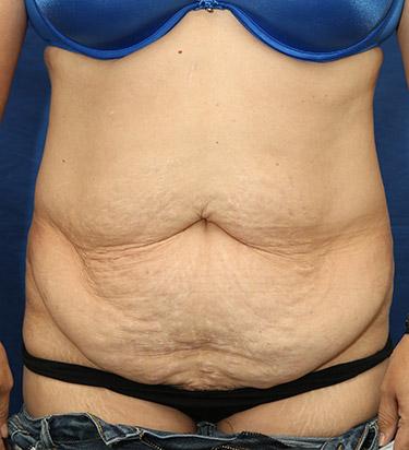 Before Results for Panniculectomy